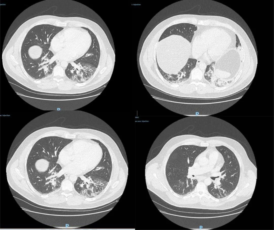 新闻联播炮轰！美市长承认去年11月得新冠，还有两大证据曝光！