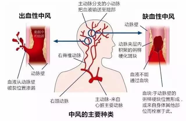 中国人的“头号杀手”不是癌症，是它！