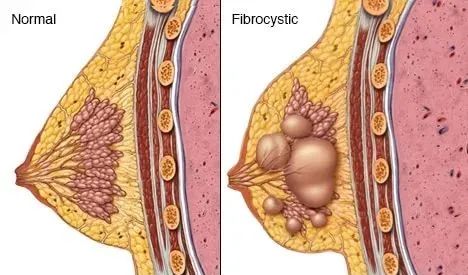 正常乳腺与囊性增生的乳腺小的乳腺结节会随着月经周期发生一些微小