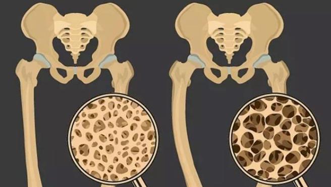 每年百万人“折”在骨质疏松上！一个公式自测「骨松」风险！